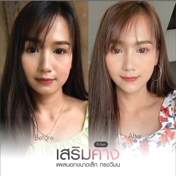 รีวิวเสริมคาง 1 เดือน