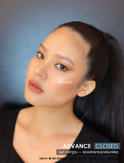 รีวิวเสริมจมูกแบบปิด ตอกฐานจมูก รองปลายกระดูกอ่อนหลังหู