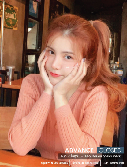 รีวิวเสริมจมูกแบบปิด ตะไบฐาน รองปลายกระดูกอ่อนหลังหู