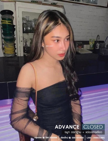 รีวิวเสริมจมูกแบบปิด แต่งปลายเรียว