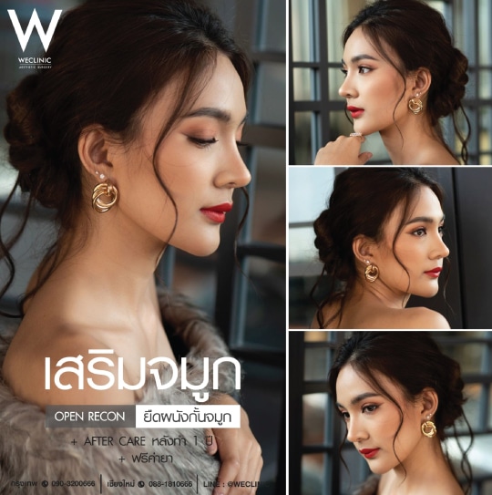 รีวิวเสริมจมูกแบบ Open Recon ยืดผนังกั้นจมูก