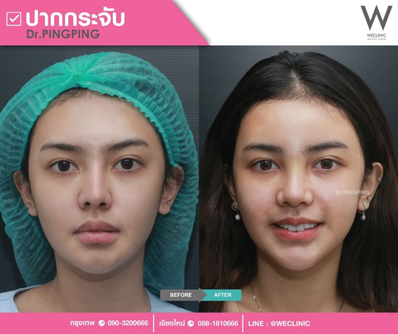 เลือกทำปากกระจับที่ไหนดี