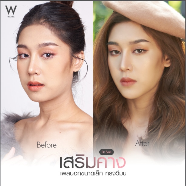 เสริมคางรีวิว