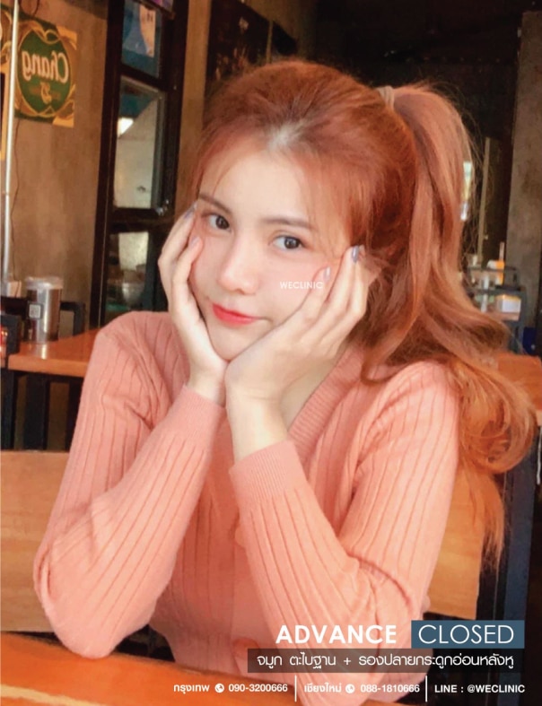เสริมจมูกแบบปิด ทำจมูกทรงหยดน้ำ