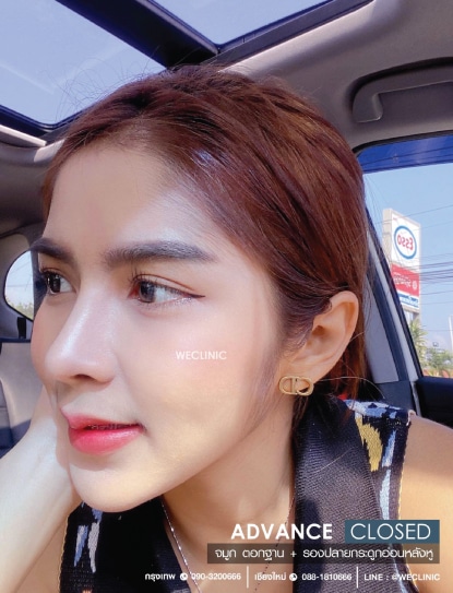 เสริมจมูก ตอกฐาน รองปลายกระดูกอ่อนหลังหู