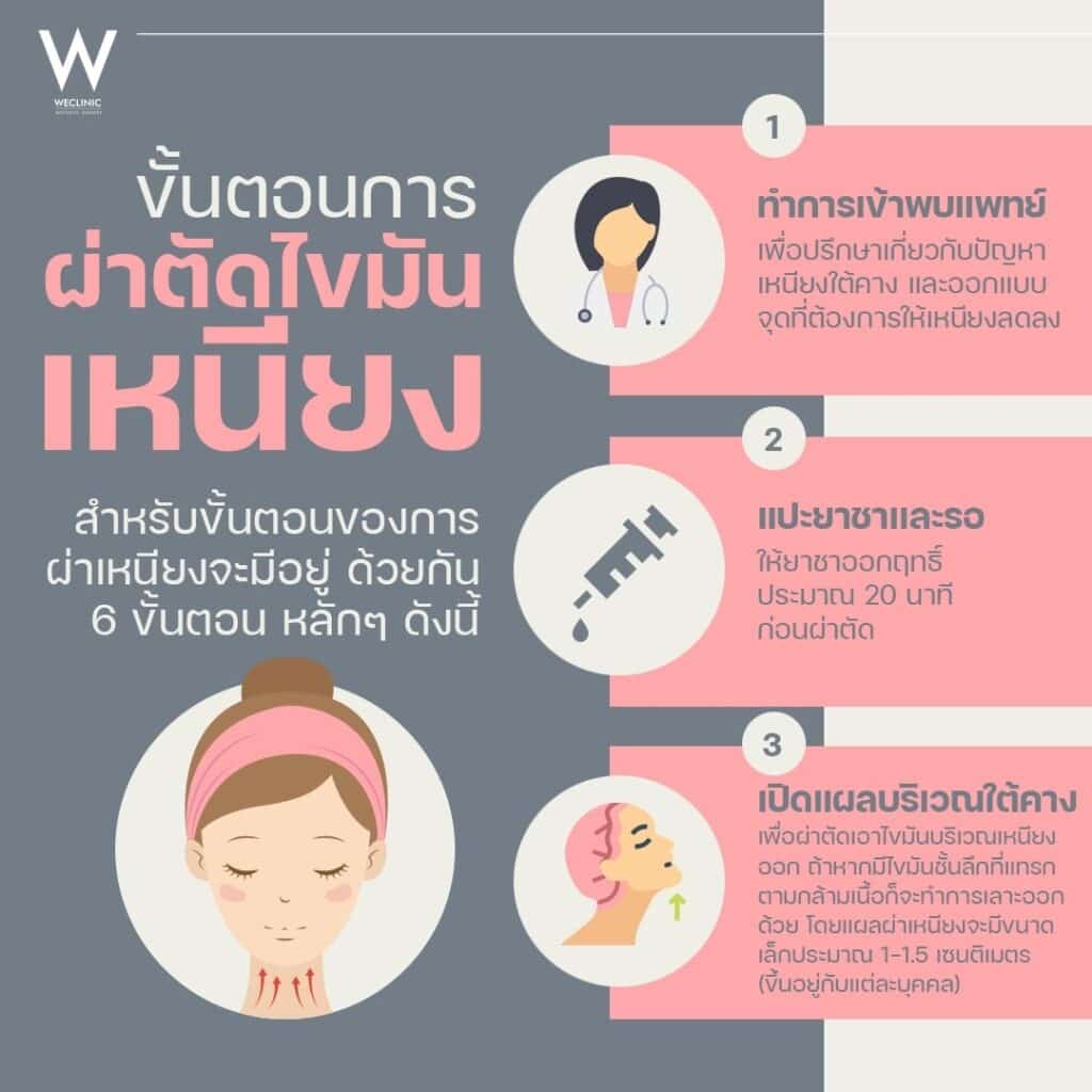 ขั้นตอนการผ่าตัดไขมันเหนียง