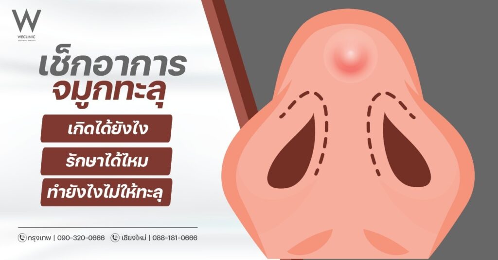 เช็กอาการจมูกทะลุ เกิดได้ยังไง รักษาได้ไหม ทำยังไงไม่ให้ทะลุ